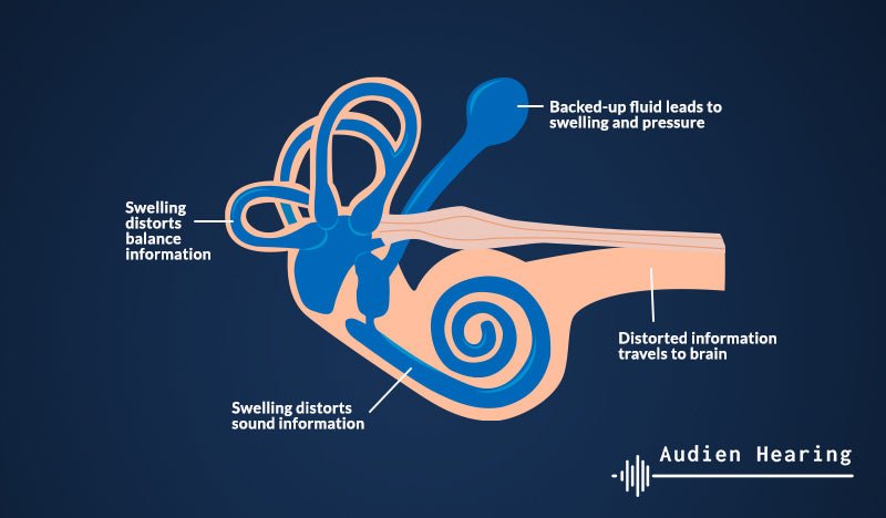 Les acouphènes neurologiques