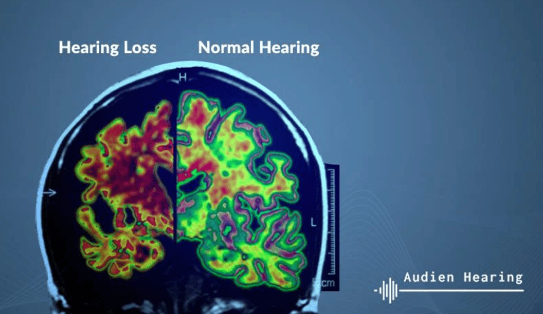 De nouvelles recherches relient la perte auditive à Alzheimer, à la démence et à la dépression