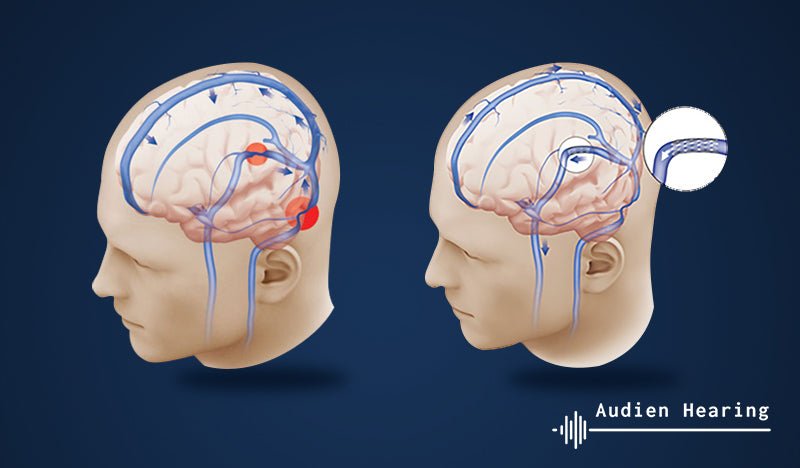 La chirurgie des acouphènes